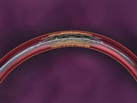 Das Wingspan Stent-System