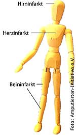 Beininfarkt