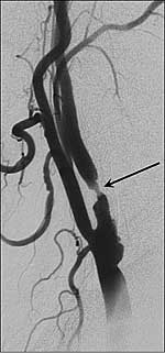 Röntgendarstellung einer Halsschlagader mit Verengung