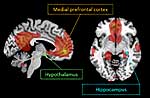 Intranasales Insulin steigert die funktionalen Verbindungen in bestimmten kognitiven Hirnregionen (Default Mode Network, DMN) sowie im Hippocampus und Hypothalamus.