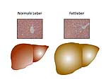 Eine gesunde Leber (links) kann eine Steatose entwickeln (rechts)