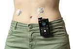 MiniMed (TM) 670G System von Medtronic am Körper